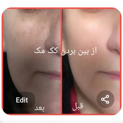 از بین بردن لک صورت