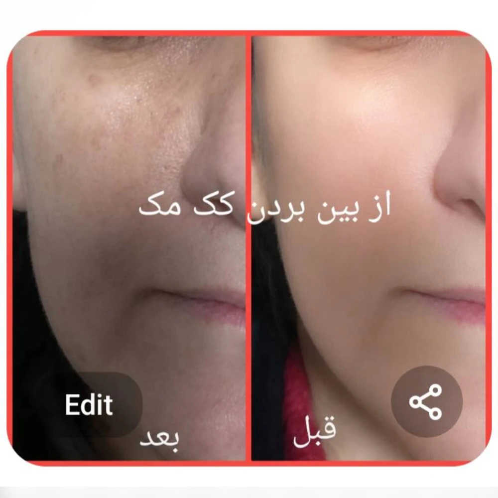 New Project (1) از بین بردن لک صورت
