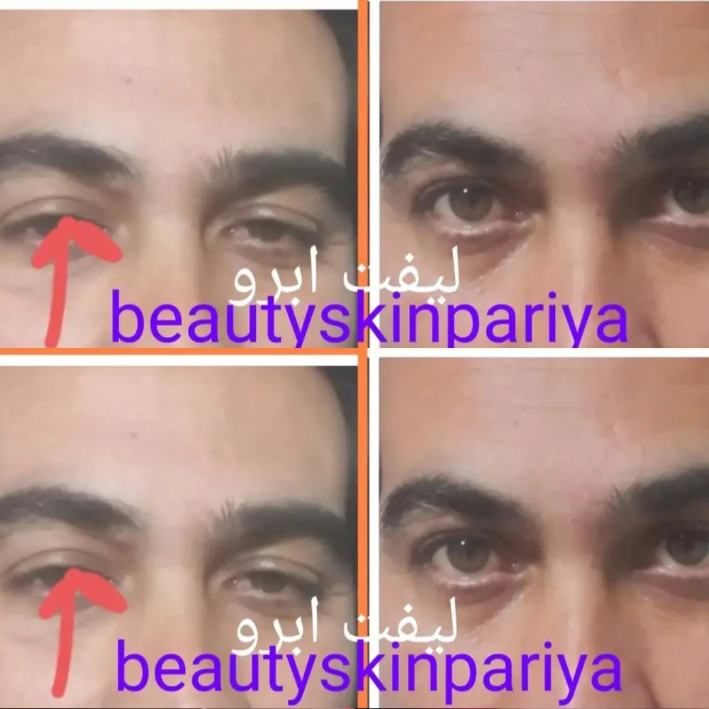New Project (2) لیفت ابرو در تهران