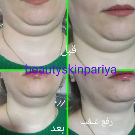 از بین بردن غبغب