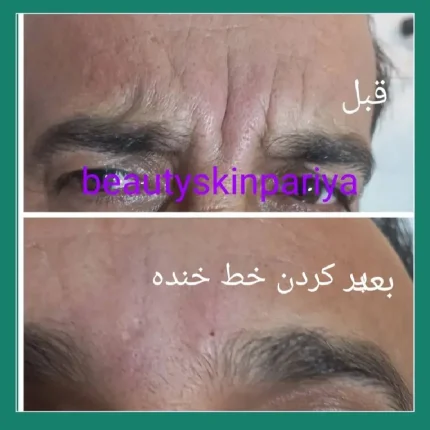 پر کردن خط اخم